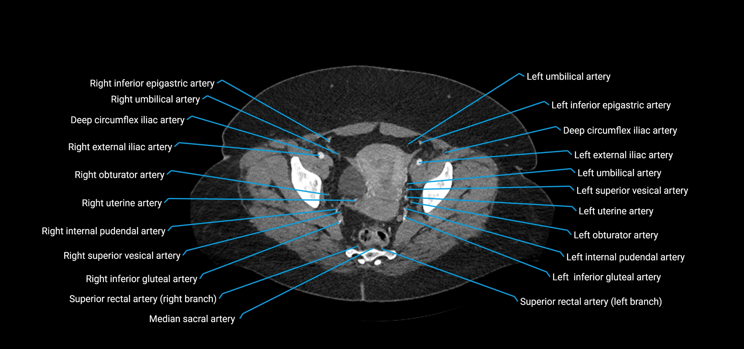 CTA abdomen axial cross sectional anatomy labelled image_224 (2).webp